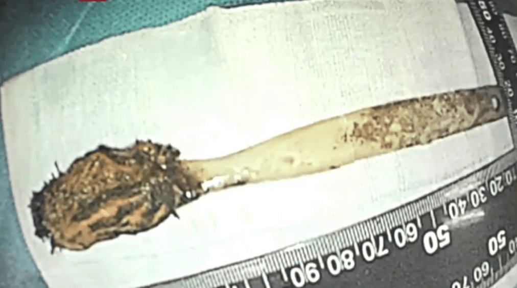 医生取出藏肠52年的“古董牙刷”。